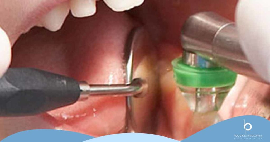 Ozonoterapia dentale | Studio Odontoiatrico Poggiolini Boldrini